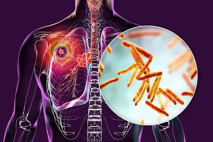 बड़ी राहत: फेफड़ों में छिपे टीबी के बैक्टीरिया पर सीधा हमला करेगी नई दवा